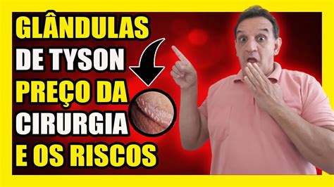 glandula de tyson|Glândulas de Tyson: o que são, porque aparecem e。